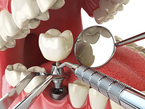 Best Emergency Denture Repair in St James, MO